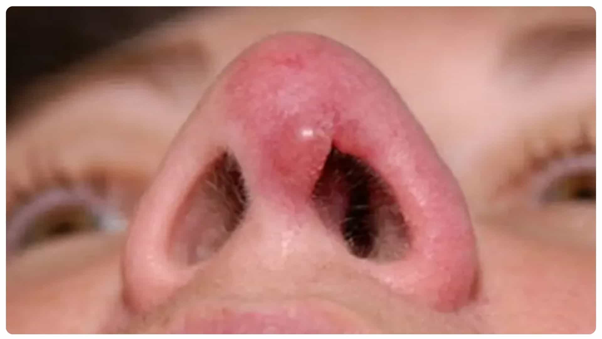 Nâng mũi bao lâu thì đầu mũi hết to? Những yếu tố ảnh hưởng 12 Nâng mũi bao lâu thì đầu mũi hết to?