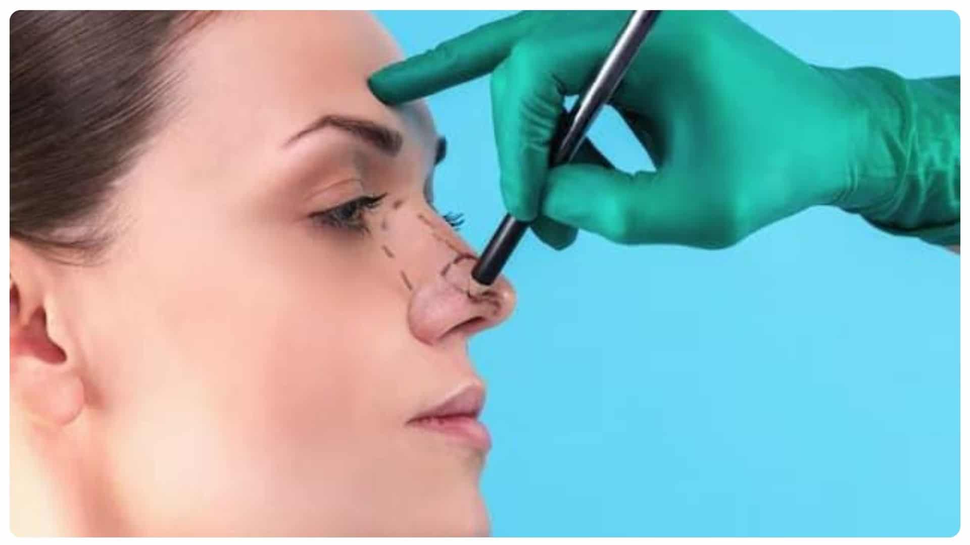 Nâng mũi bao lâu thì đầu mũi hết to? Những yếu tố ảnh hưởng 15 nang mui bao lau thi dau mui het to 8