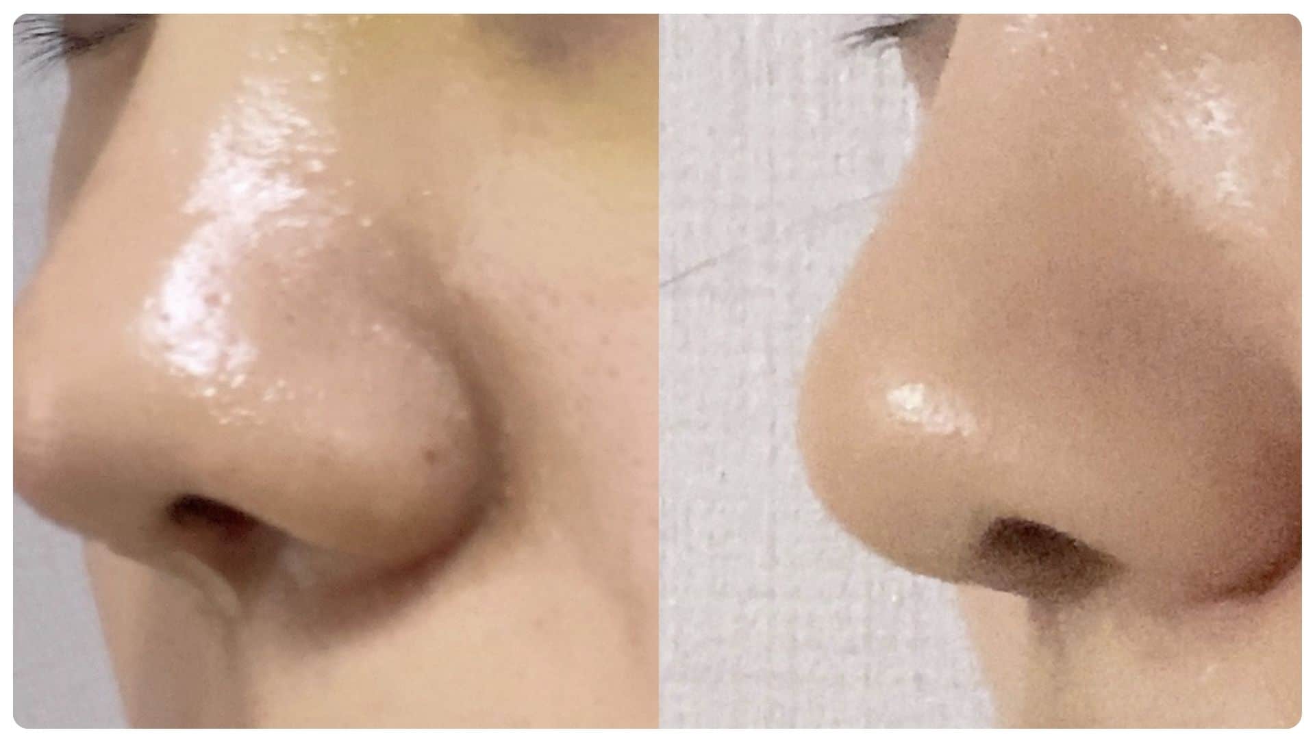 Nâng mũi bao lâu thì đầu mũi hết to? Những yếu tố ảnh hưởng 13 nang mui bao lau thi dau mui het to 9