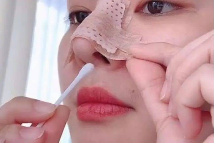 Nâng mũi cấu trúc bao lâu thì gom lại? Quá trình mũi gom lại 12 nang mui cau truc bao lau thi gom lai 4