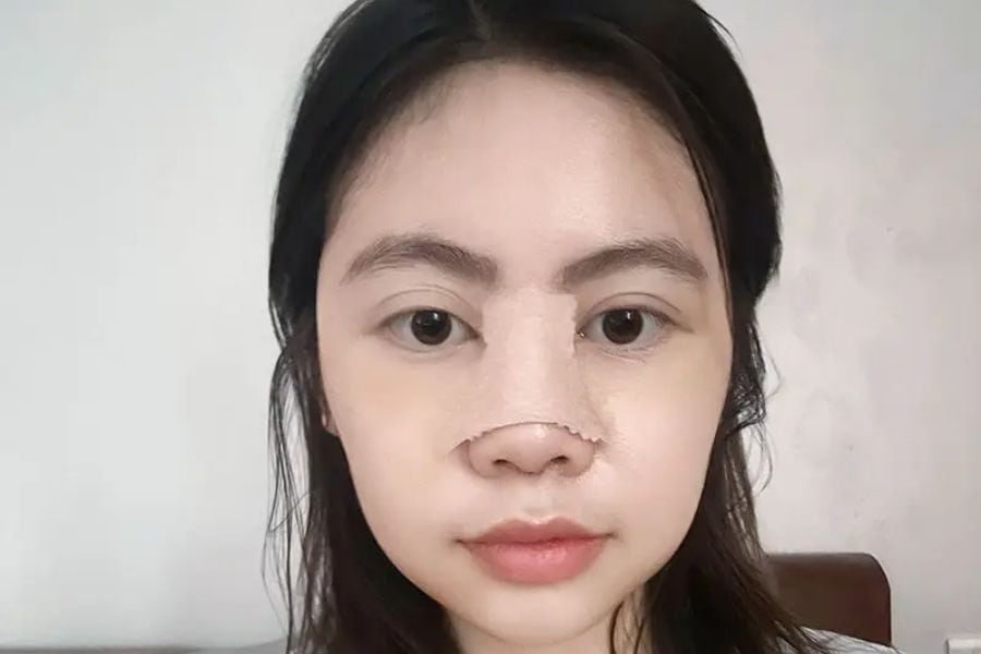 Nâng mũi cấu trúc bao lâu thì gom lại? Quá trình mũi gom lại 13 nang mui cau truc bao lau thi gom lai 5