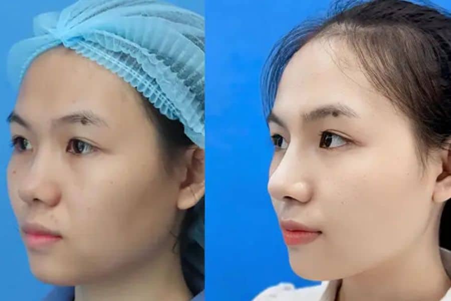 Nâng mũi cấu trúc bao lâu thì gom lại? Quá trình mũi gom lại 14 nang mui cau truc bao lau thi gom lai 6