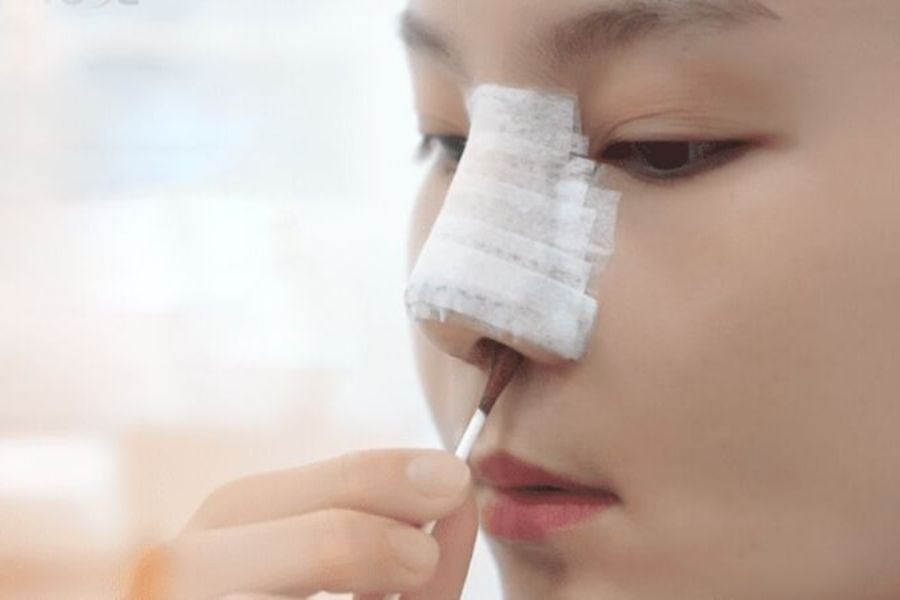 Nâng mũi cấu trúc bao lâu thì gom lại? Quá trình mũi gom lại 15 nang mui cau truc bao lau thi gom lai 7