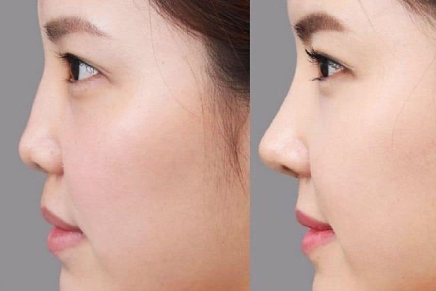 Nâng mũi cấu trúc được bao lâu? Các yếu tố ảnh hưởng 14 Nâng mũi cấu trúc tạo dáng mũi thanh thoát phù hợp mặt