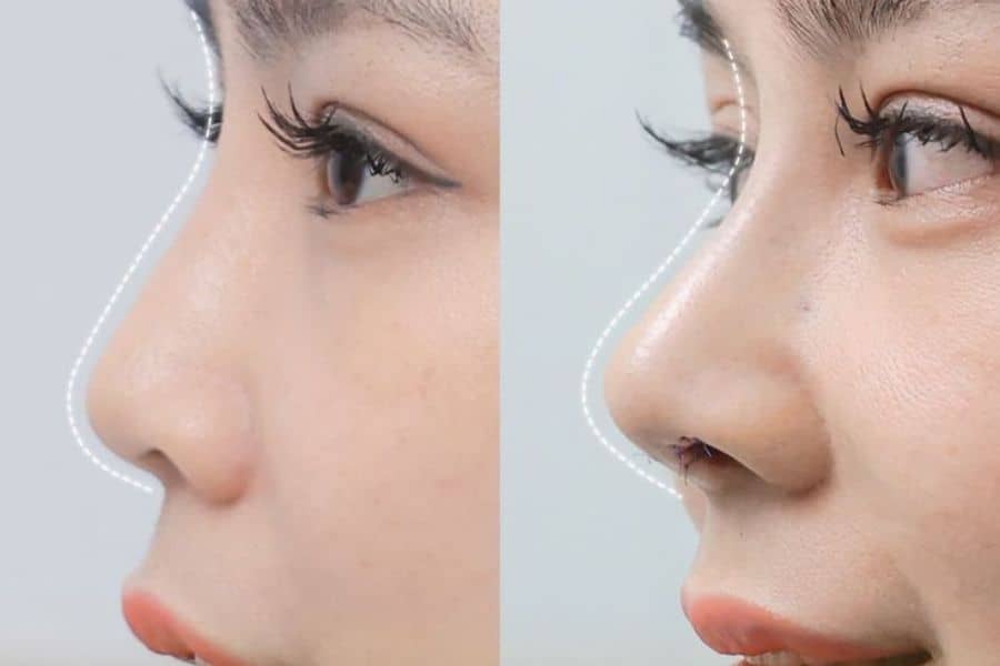 Có nên nâng mũi không, những ai nên và không nên nâng mũi? 9 Nâng mũi giúp gương mặt đẹp hơn