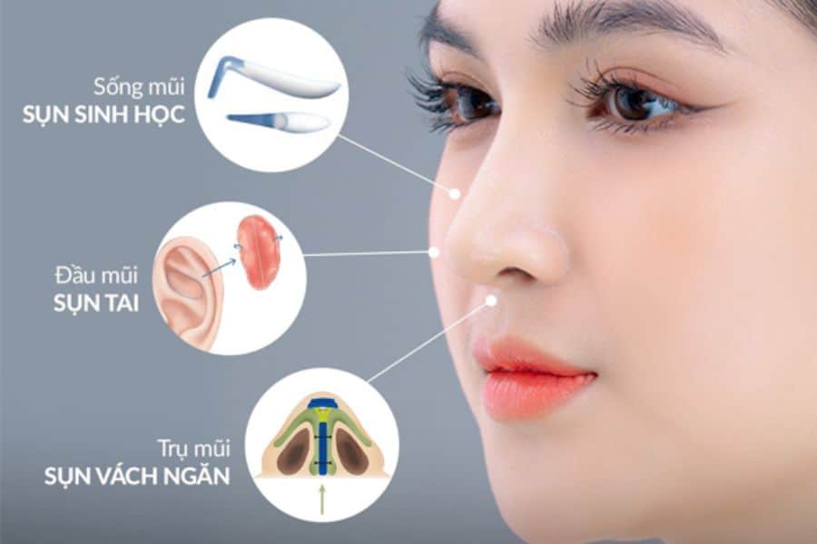 Có nên nâng mũi không, những ai nên và không nên nâng mũi? 12 Nên chọn phương pháp nâng mũi phù hợp