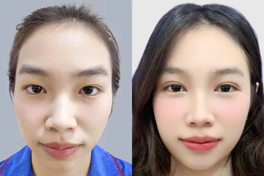 Nhấn mí kiêng gì? – TOP 6+ thực phẩm cần kiêng 17 Nên kiêng ăn và sinh hoạt theo hướng dẫn để phục hồi tốt sau nhấn mí