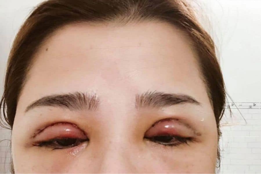 TOP 7+ cách giảm sưng mắt sau cắt mí và lưu ý nên biết 11 Nhiều chị em lo lắng sau khi cắt mí mắt bị sưng