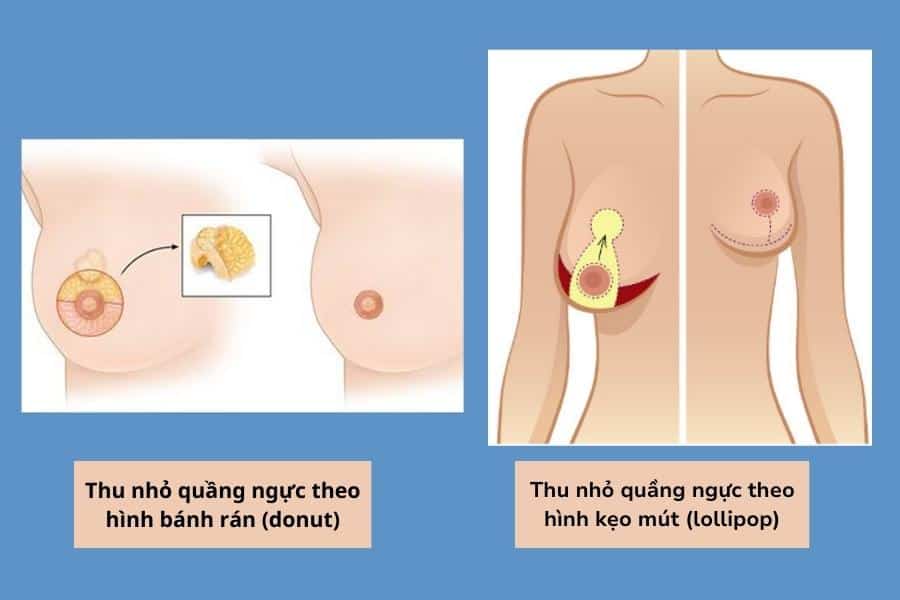 Thu nhỏ quầng nhũ hoa giá bao nhiêu? Bảng giá mới nhất 2026 14 Phương pháp thu nhỏ quầng nhũ hoa hình bánh rán và hình kẹo mút