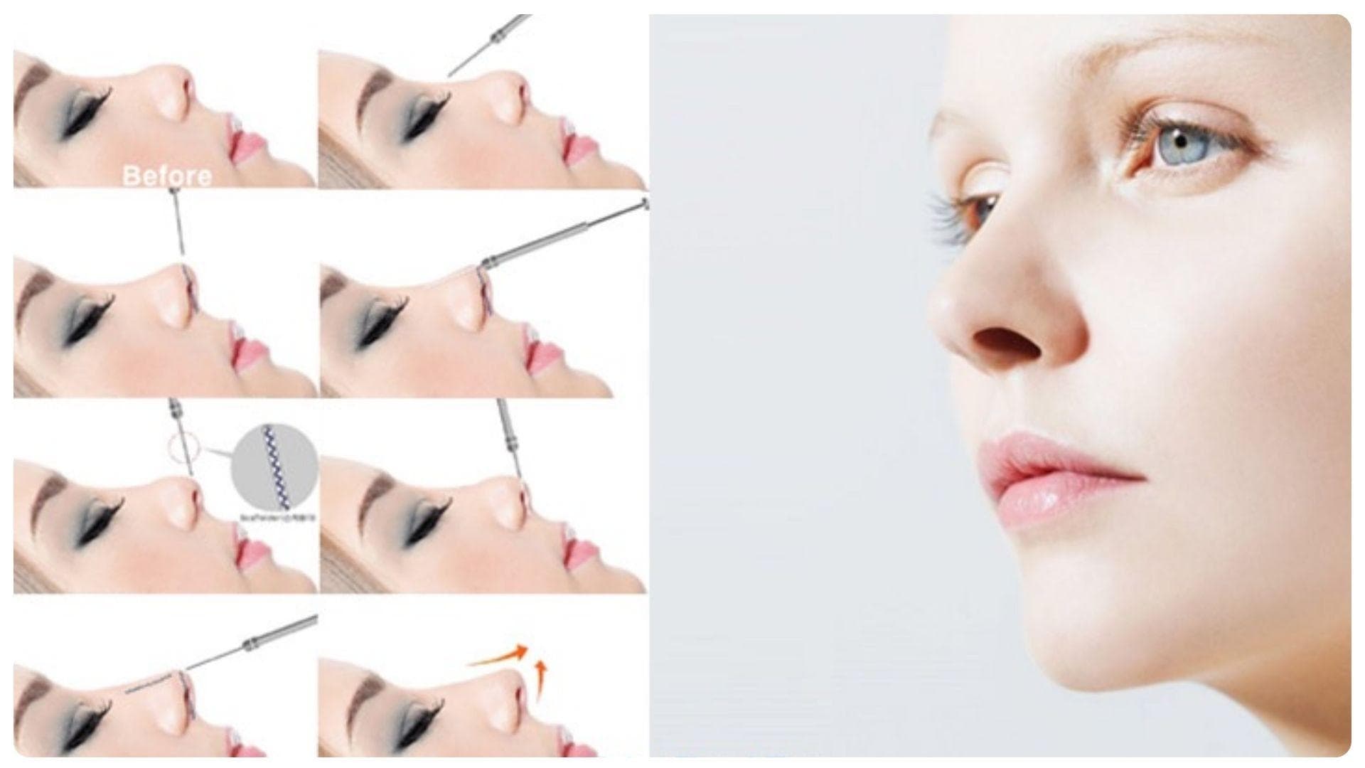 Nâng mũi chỉ giữ được bao lâu? Cách chăm sóc dáng mũi bền lâu 17 Quy trình nâng mũi chuyên nghiệp, an toàn giúp khách hàng an tâm về chất lượng