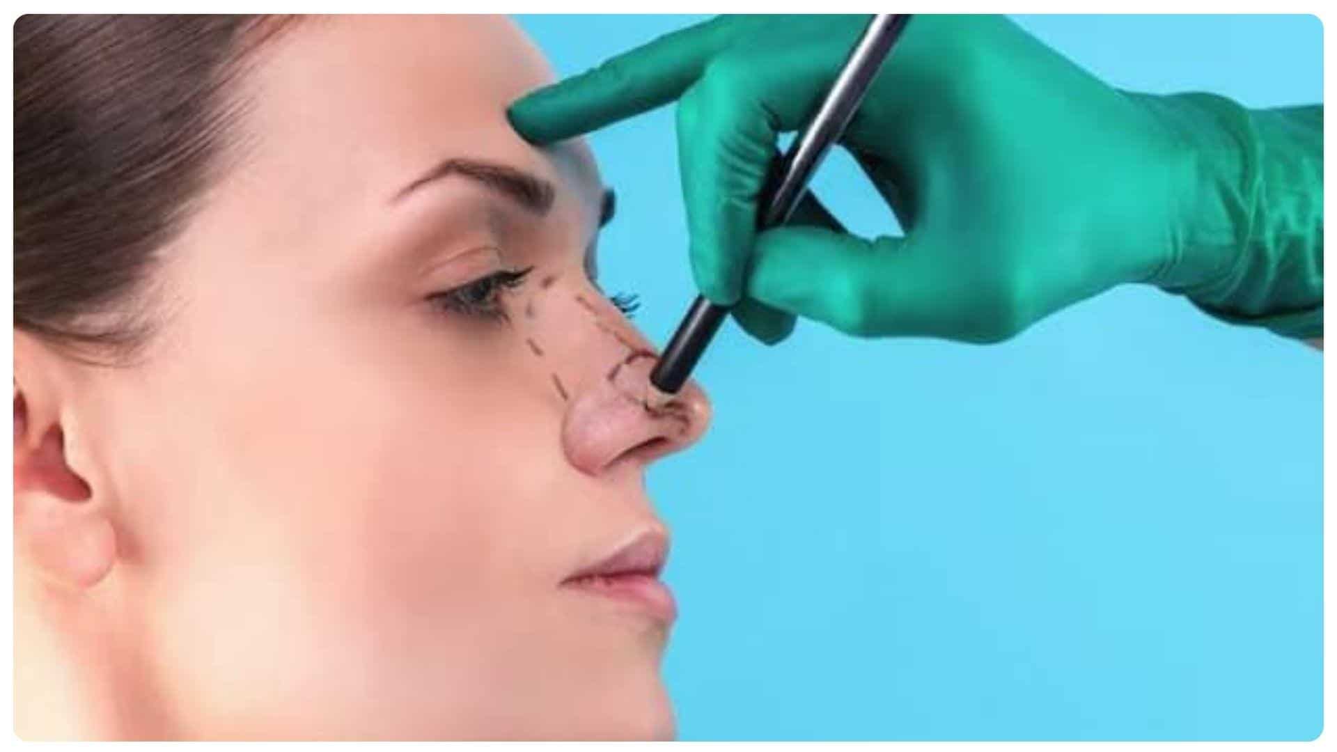 Dấu hiệu mũi không hợp sụn và cách phòng ngừa 23 Quy trình nâng mũi tại BVTM Ngọc Dung đảm bảo an toàn trong thẩm mỹ