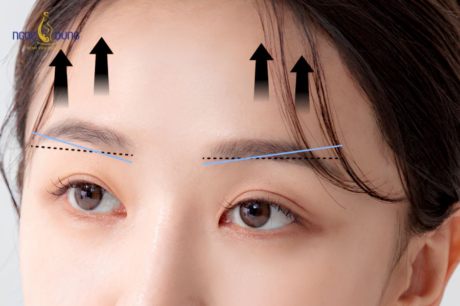 Nâng cung chân mày có để lại sẹo không? Bao lâu thì hết sẹo 12 Sự thay đổi của đường cung mày theo thời gian, mờ hẳn và phẳng mịn hoàn toàn sau 3 - 6 tháng