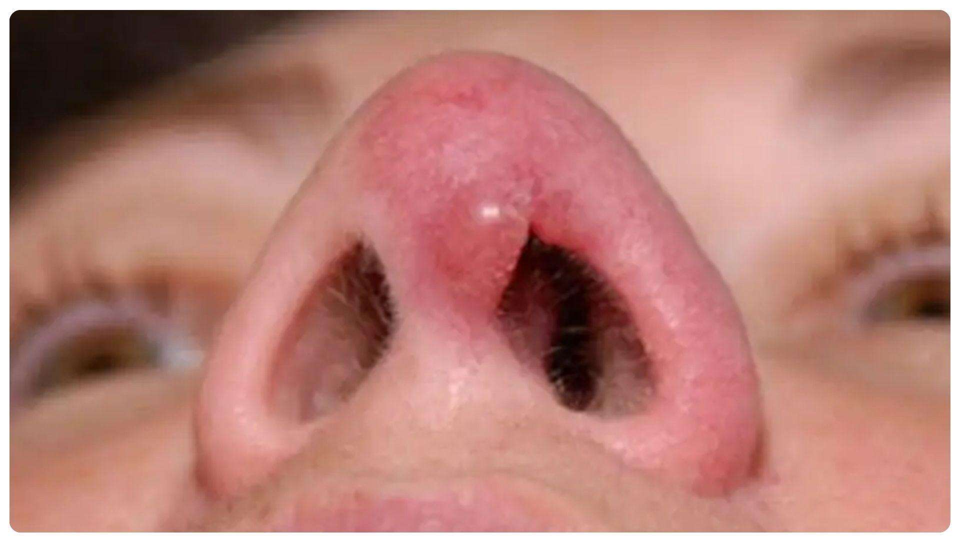 Dấu hiệu mũi không hợp sụn và cách phòng ngừa 14 Sưng kéo dài sau nâng mũi có thể là dấu hiệu cần theo dõi