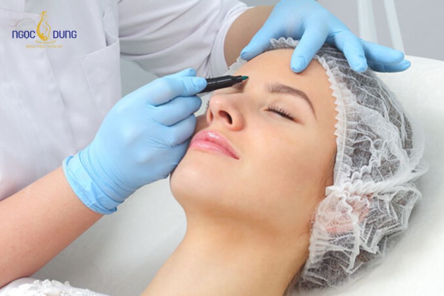 Nâng cung chân mày có để lại sẹo không? Bao lâu thì hết sẹo 11 Thao tác đo vẽ tỉ lệ chuẩn xác và kỹ thuật bóc tách chuyên sâu của bác sĩ quyết định đến 80% kết quả lành thương
