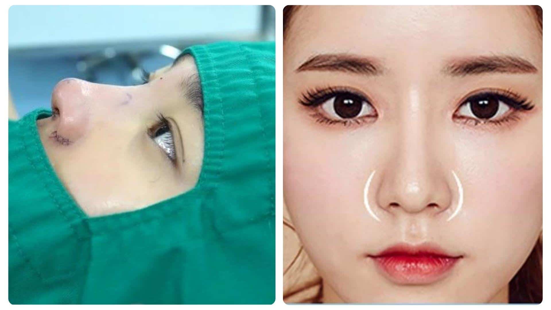 Phẫu thuật thu gọn cánh mũi bao lâu thì lành? 11 Thu gọn cánh mũi đúng kỹ thuật, vết thương lành nhanh, dáng mũi tự nhiên