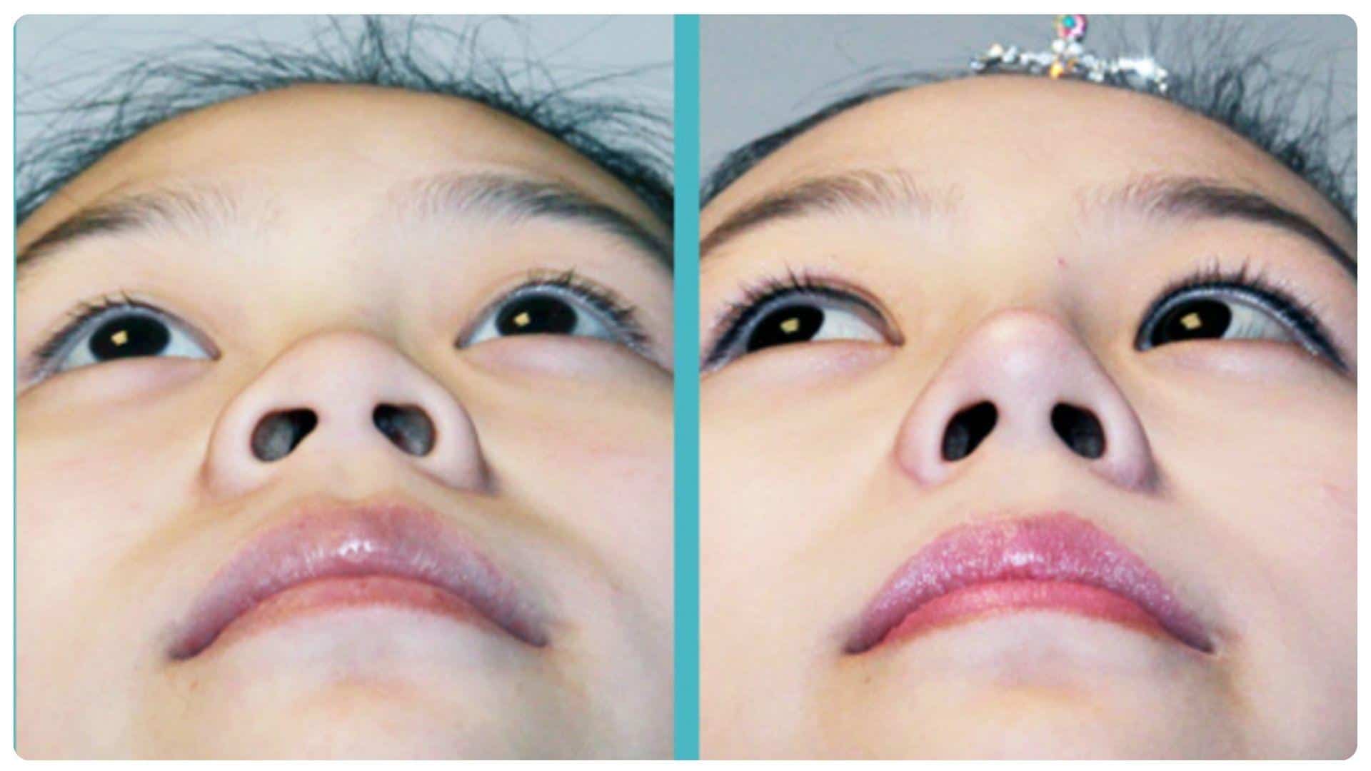 Phẫu thuật thu gọn cánh mũi bao lâu thì lành? 8 Thu gọn cánh mũi đúng kỹ thuật, vết thương lành nhanh, dáng mũi tự nhiên