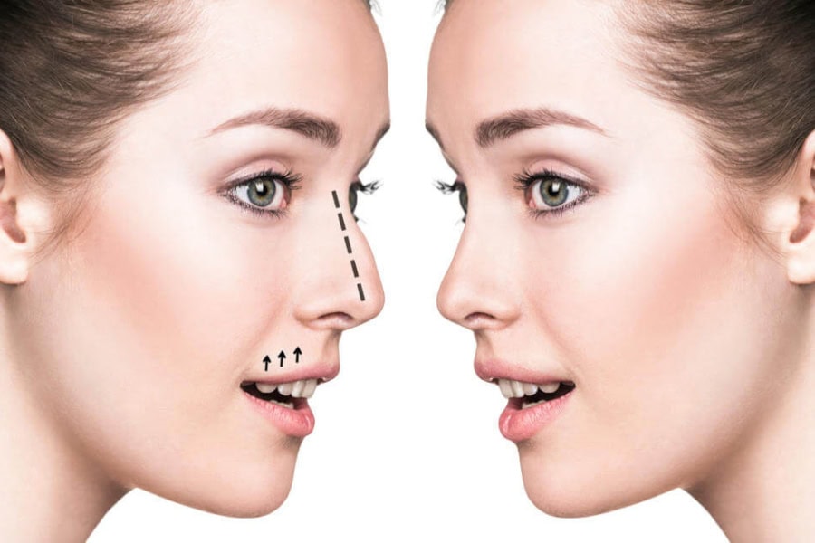 Tiêm chất làm đầy nâng mũi hiệu quả bao lâu? Giải đáp từ A-Z 16 Tiêm filler mũi giúp nâng cao sống mũi, mũi thẳng và thanh thoát hơn