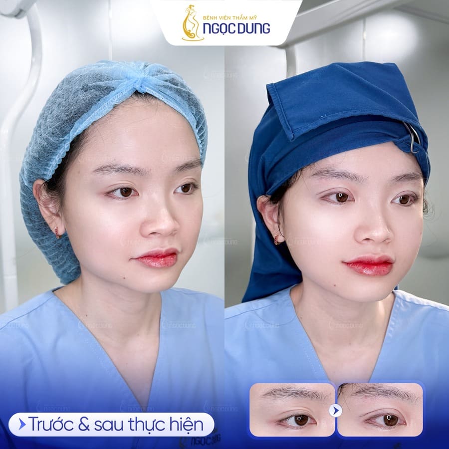 Cắt mí bao lâu thì lành? Thời gian cần để mí mắt đẹp tự nhiên 16 Trải nghiệm dịch vụ thẩm mỹ mắt đẳng cấp, an toàn và chu đáo tại Hệ thống Ngọc Dung