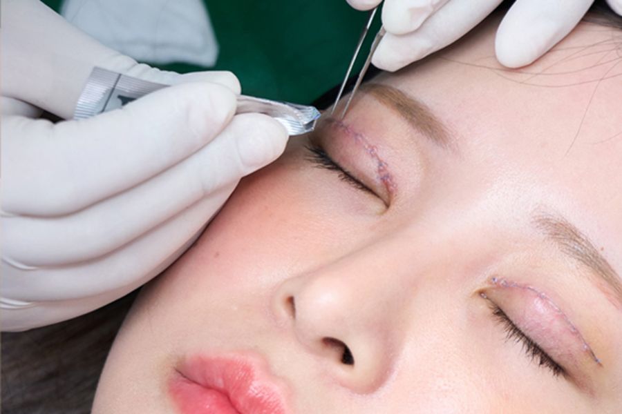 Cắt mí mắt bao lâu thì lành? Cách chăm sóc sau cắt mí 14 Tuân theo hướng dẫn chăm sóc của bác sĩ để vết thương nhanh hồi phục