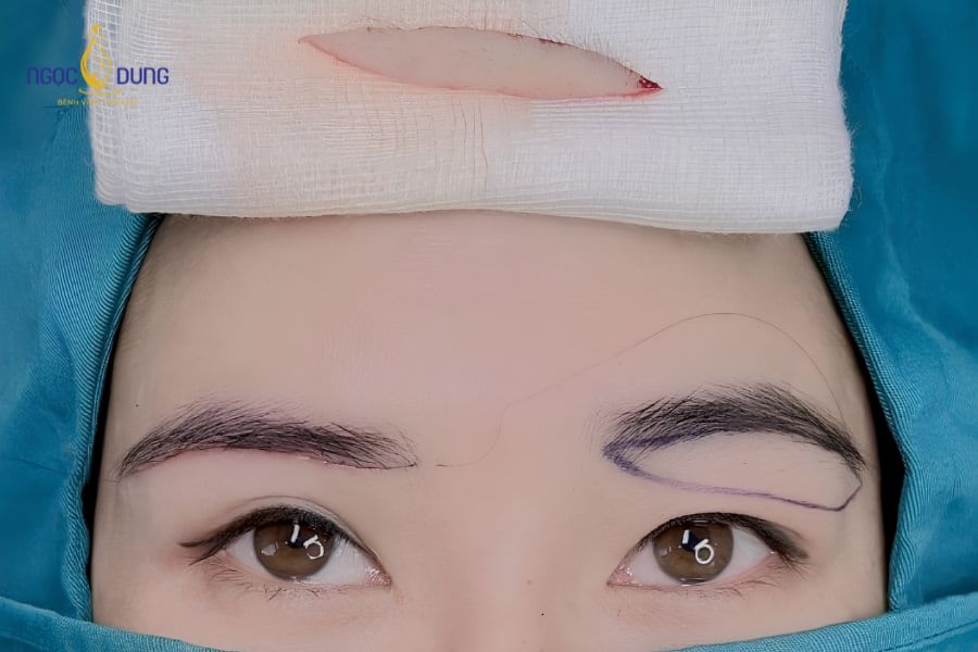 Nâng cung chân mày có để lại sẹo không? Bao lâu thì hết sẹo 13 Tuân thủ hướng dẫn chăm sóc và thoa gel phục hồi giúp vết mổ nhanh ổn định qua từng giai đoạn