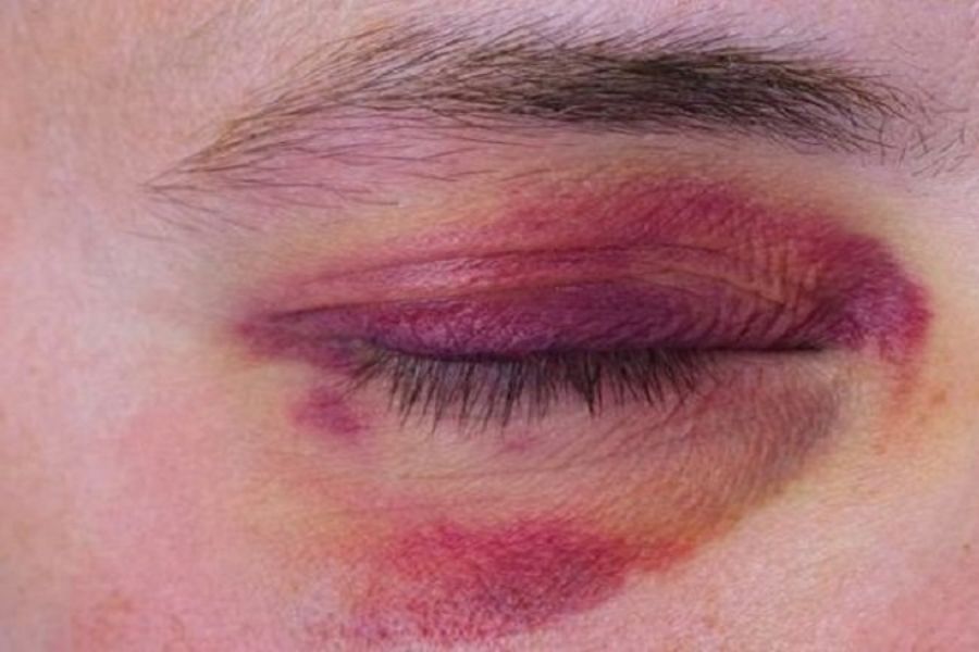 Cắt mí mắt bao lâu thì lành? Cách chăm sóc sau cắt mí 13 Tùy cơ địa sẽ có tình trạng sưng tím khác nhau