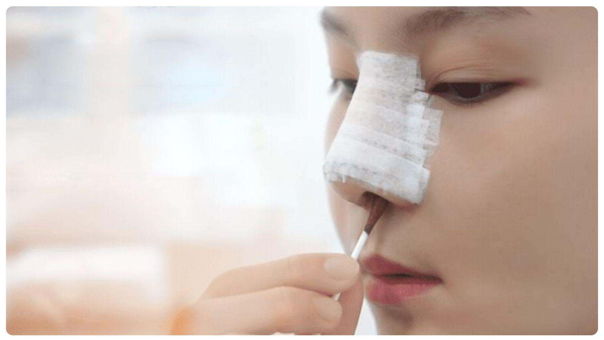 Phẫu thuật thu gọn cánh mũi bao lâu thì lành? 9 Vệ sinh mũi đúng cách là bí quyết để rút ngắn thời gian hồi phục