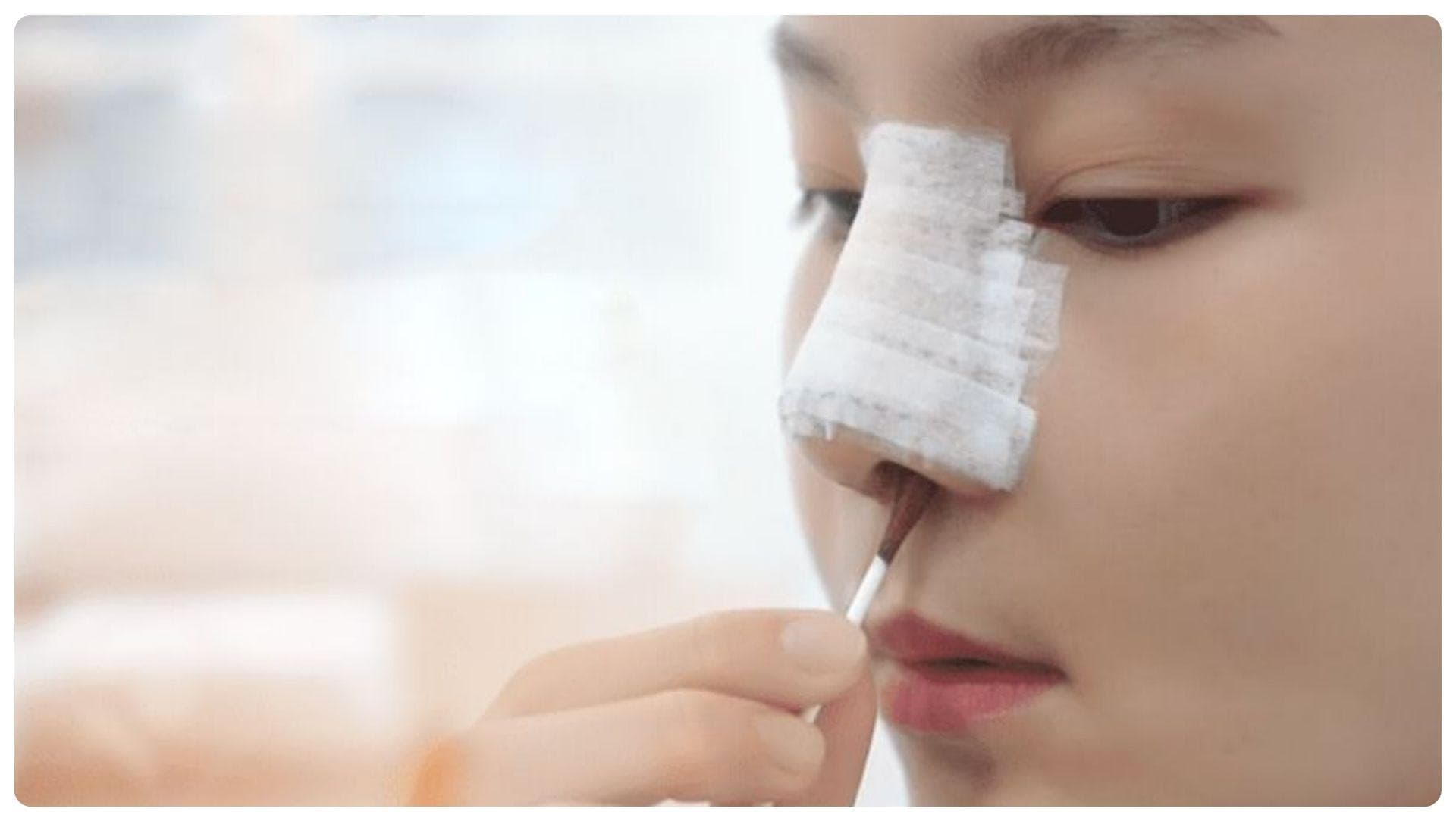 Nâng mũi chỉ giữ được bao lâu? Cách chăm sóc dáng mũi bền lâu 15 Vệ sinh và chăm sóc mũi đúng cách giúp giảm sưng và duy trì dáng mũi ổn định