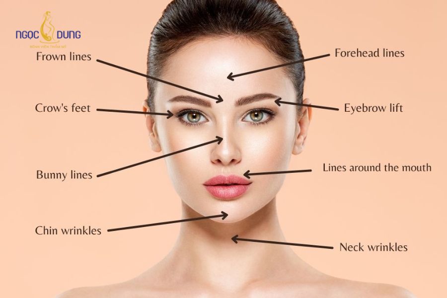 Tiêm Botox là gì? Những công dụng của tiêm botox hiện nay 10 Botox được ứng dụng trong làm đẹp để xóa đi các khuyết điểm xóa nhăn các vùng