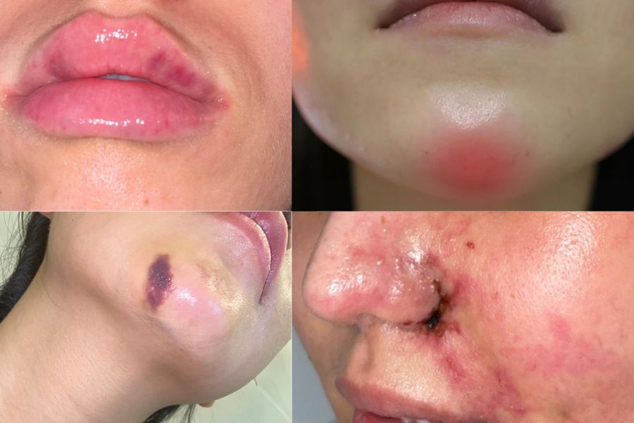 Tiêm filler bao lâu thì hết sưng? Cách giảm sưng an toàn 17 Cần đến thăm khám bác sĩ ngay khi gặp hiện tượng sưng tím kéo dài