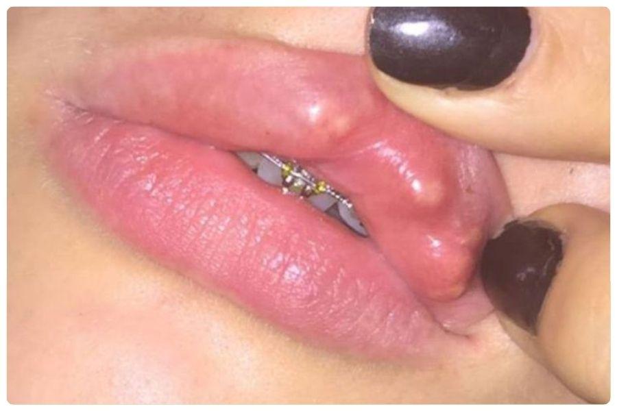 Tiêm filler bị vón cục: Nguyên nhân, dấu hiệu và cách khắc phục 15 Cần liên hệ bác sĩ ngày nếu xuất hiện dấu hiệu bất thường sau khi tiêm filler