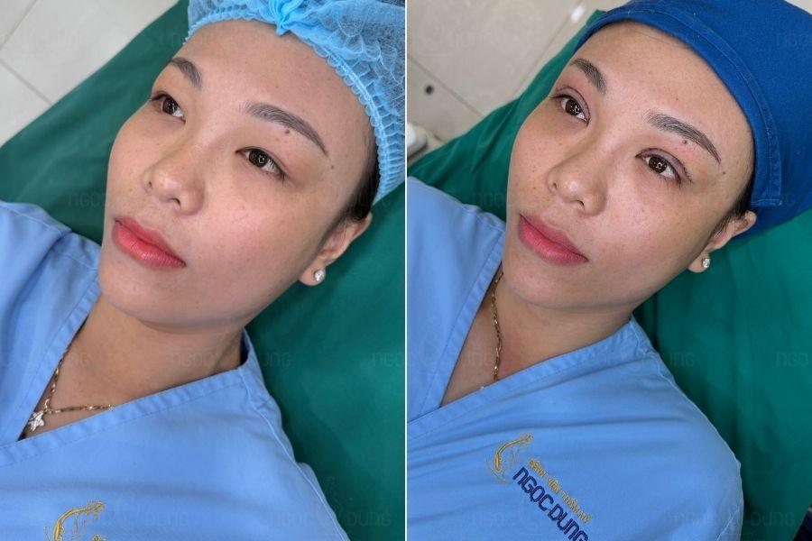 Cắt mí mắt có đau không? Địa chỉ cắt mí an toàn, uy tín 14 Cắt mí mắt tại BVTM Ngọc Dung