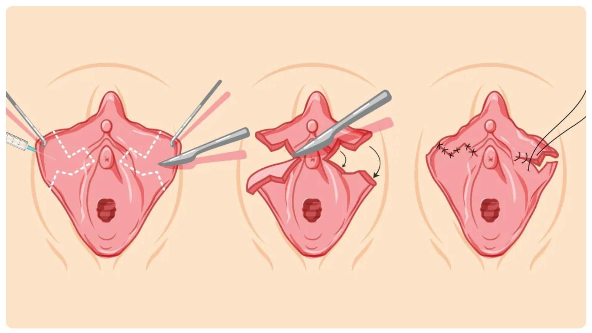 Cắt môi bé bao lâu thì lành? Quy trình hồi phục và chăm sóc 10 Cắt môi bé giúp thu gọn và tạo hình vùng kín