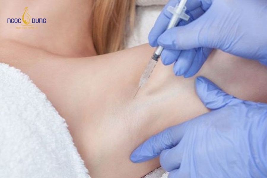 Tiêm botox trị hôi nách có hiệu quả? Đánh giá từ chuyên gia 10 Cơ chế của botox là ngăn chặn chất dẫn truyền thần kinh, ngăn tuyến mồ hôi tiết dầu