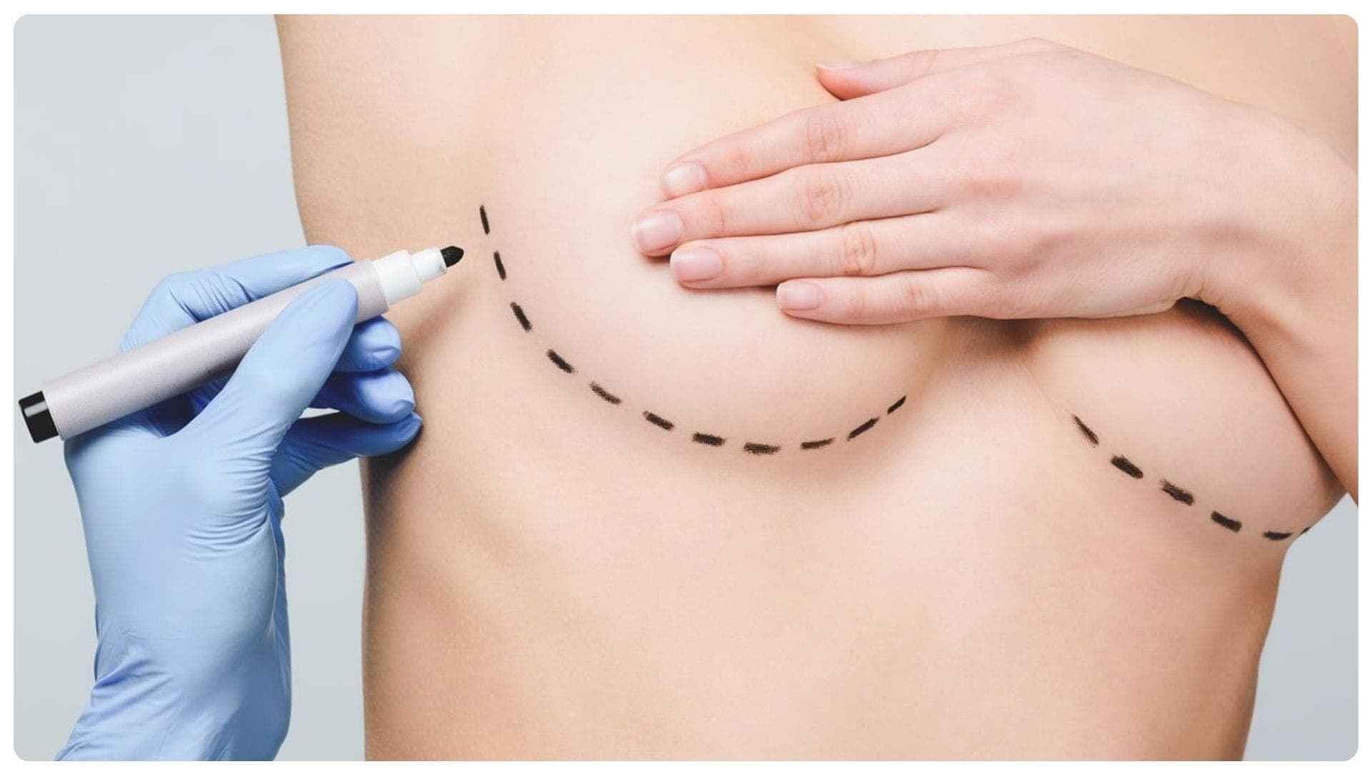 Nâng ngực bao lâu thì mềm? Những yếu ảnh hưởng cần lưu ý 13 Cơ địa ảnh hưởng đến tốc độ mềm của ngực