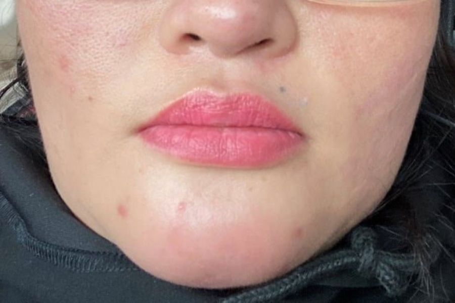 Tiêm tan filler bị sưng phải làm sao? Cách giảm sưng hiệu quả 11 Có nhiều nguyên nhân khiến tiêm tan filler bị sưng