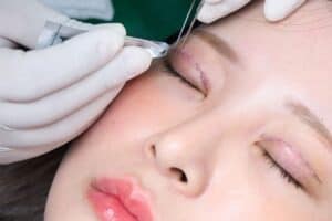 Có thể cắt chỉ sau 5-7 ngày cắt mí mắt