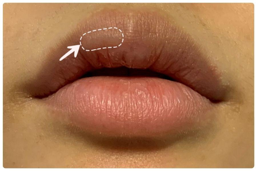 Tiêm filler bị vón cục: Nguyên nhân, dấu hiệu và cách khắc phục 14 Filler môi bị vón cục khiến đôi môi kém mềm mại và thiếu tự nhiên