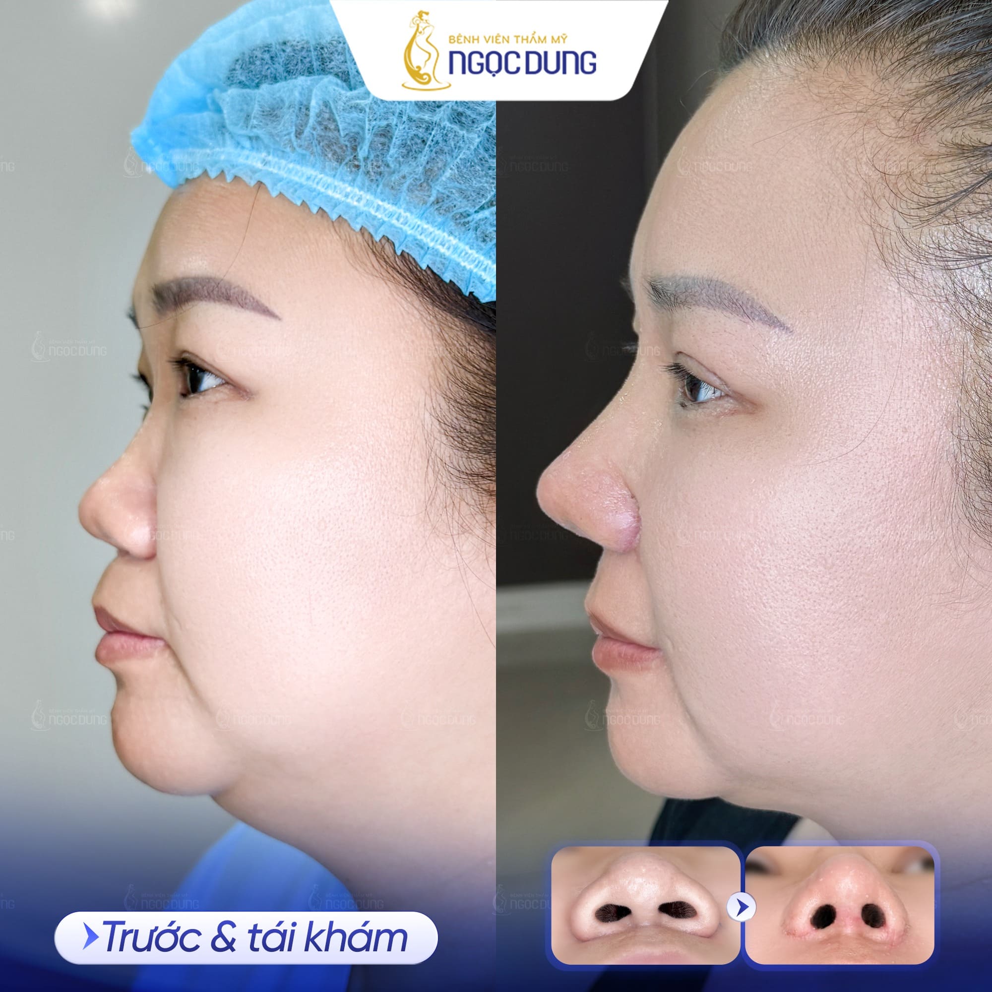 Nâng mũi Nanoform là gì? Lưu ý khi nâng mũi Nanoform 12 Hình ảnh khách trước và sau nâng mũi tại Bệnh viện thẩm mỹ Ngọc Dung
