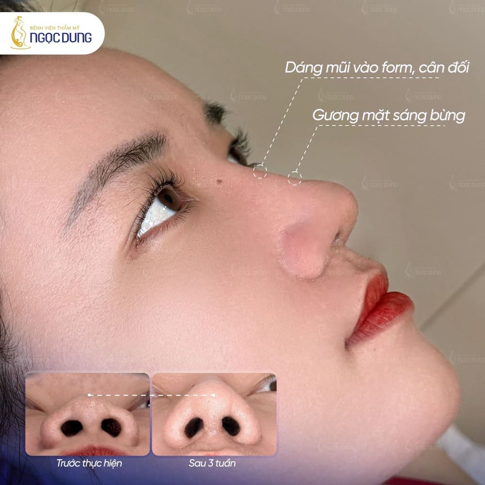 Nâng mũi bọc sụn là gì? Có những phương pháp nào 12 Hình ảnh khách trước và sau nâng mũi tại Bệnh viện thẩm mỹ Ngọc Dung