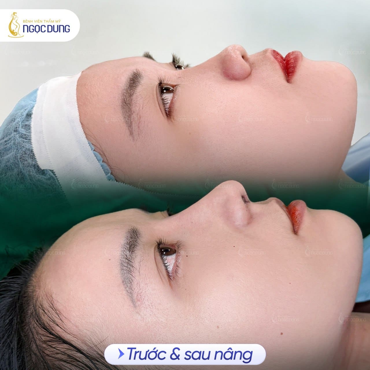 Nâng mũi Nanoform là gì? Lưu ý khi nâng mũi Nanoform 11 Hình ảnh khách trước và sau nâng mũi tại Bệnh viện thẩm mỹ Ngọc Dung