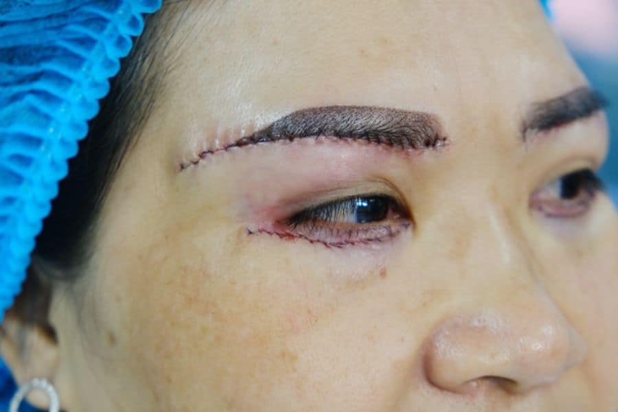 Nâng cung mày bao lâu thì hết sẹo? Yếu tố nào ảnh hưởng 11 Kỹ thuật nâng cung chân mày tác động nhiều tới hình thành sẹo