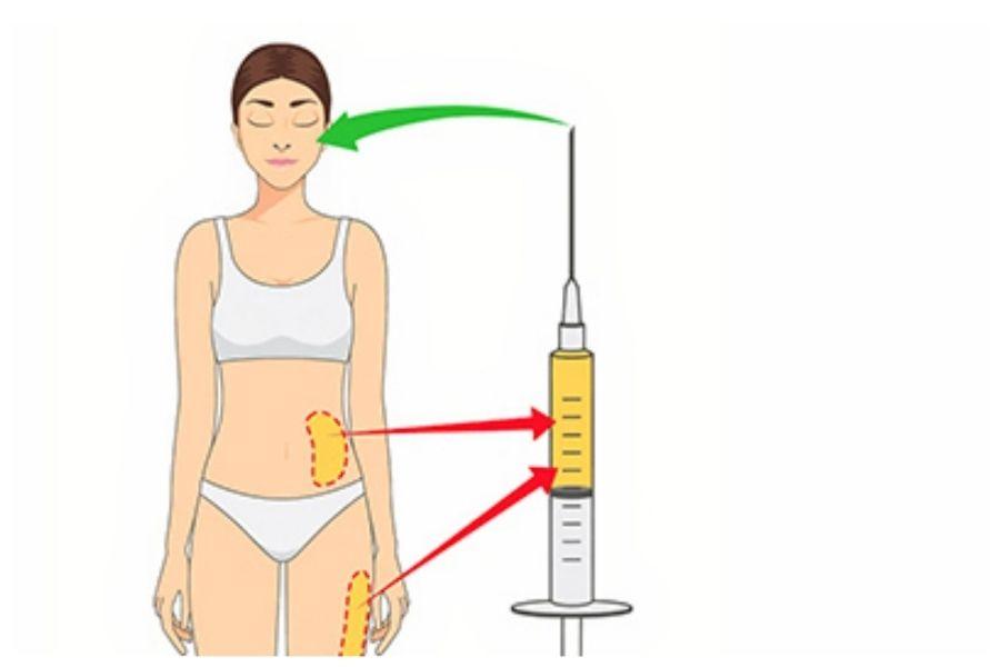 Nên Cấy Mỡ Tự Thân Hay Tiêm Filler? Nên chọn phương pháp nào 9 Lấy mỡ từ bụng, đùi hoặc tay, xử lý rồi cấy vào vùng cần làm đầy như má, mặt