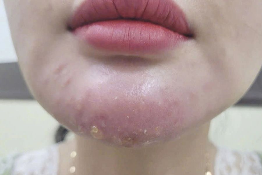 Tiêm filler cằm bao lâu thì đẹp tự nhiên? Những yếu tố liên quan 18 Lựa chọn cơ sở làm đẹp uy tín để hạn chế tối đa các biến chứng