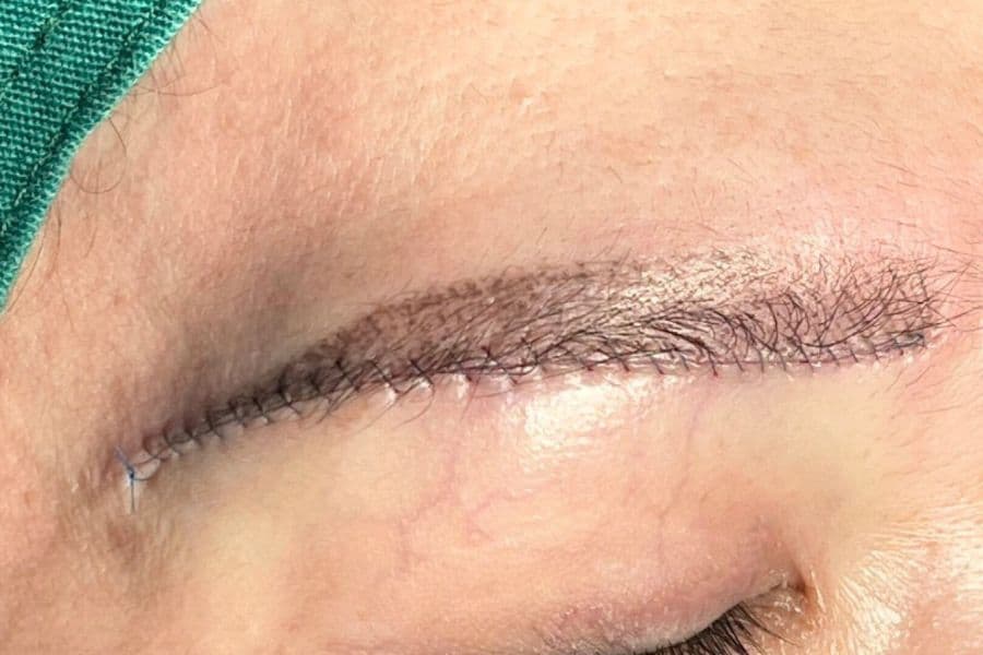 Nâng cung mày bao lâu thì hết sẹo? Yếu tố nào ảnh hưởng 8 Nâng cung chân mày là lựa chọn phổ biến hiện nay