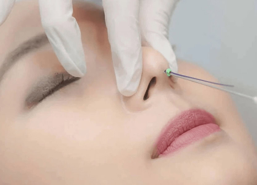 Nâng mũi bằng chỉ như thế nào là thắc mắc của nhiều người hiện nay