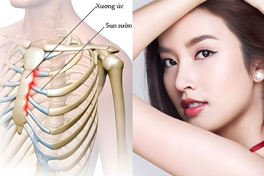 Nâng mũi bọc sụn là gì? Có những phương pháp nào 8 Nâng mũi bọc sụn sườn mang lại hiệu quả tối ưu