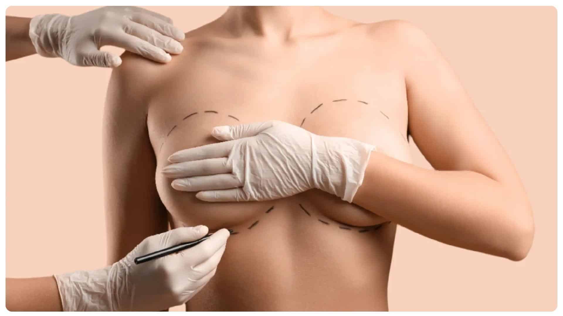 Nâng ngực bao lâu thì mềm? Những yếu ảnh hưởng cần lưu ý 12 Nâng ngực giúp vòng 1 trở nên đầy đặn, cân đối và cuốn hút hơn