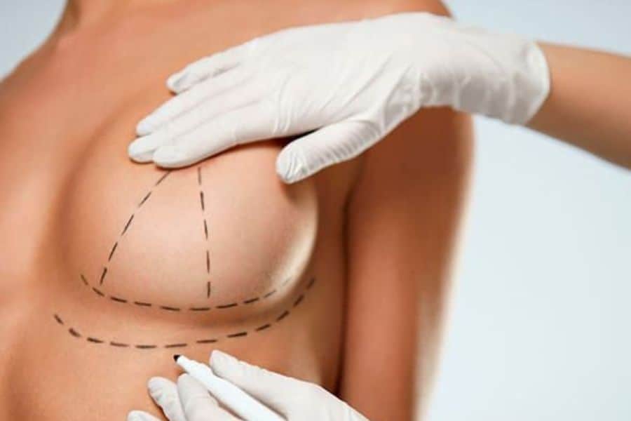 Nâng ngực có được vĩnh viễn không? Yếu tố ảnh hưởng 18 Nâng ngực trông tự nhiên và không để lại sẹo khi bạn chọn đúng cơ sở uy tín