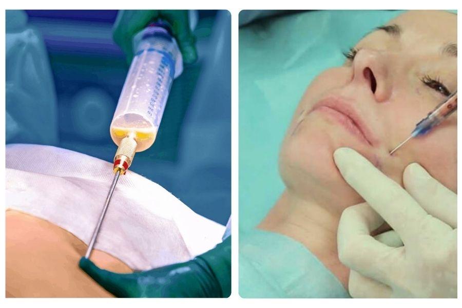 Nên Cấy Mỡ Tự Thân Hay Tiêm Filler? Nên chọn phương pháp nào 11 Nên chọn thực hiện cấy mỡ tự thân tại các cơ sở thẩm mỹ uy tín