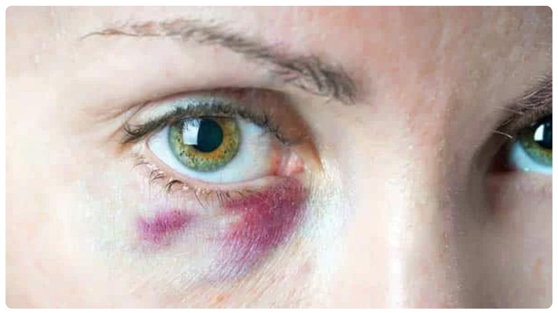 Tiêm filler có hại về sau không? 7 tác dụng phụ thường gặp 16 Nếu bầm tím lan rộng sau tiêm, nên liên hệ bác sĩ để kiểm tra sớm